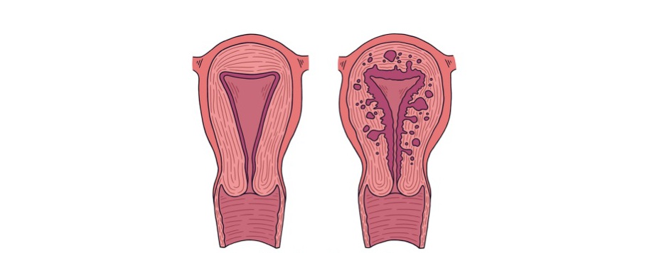 внутренний диффузный эндометриоз матки