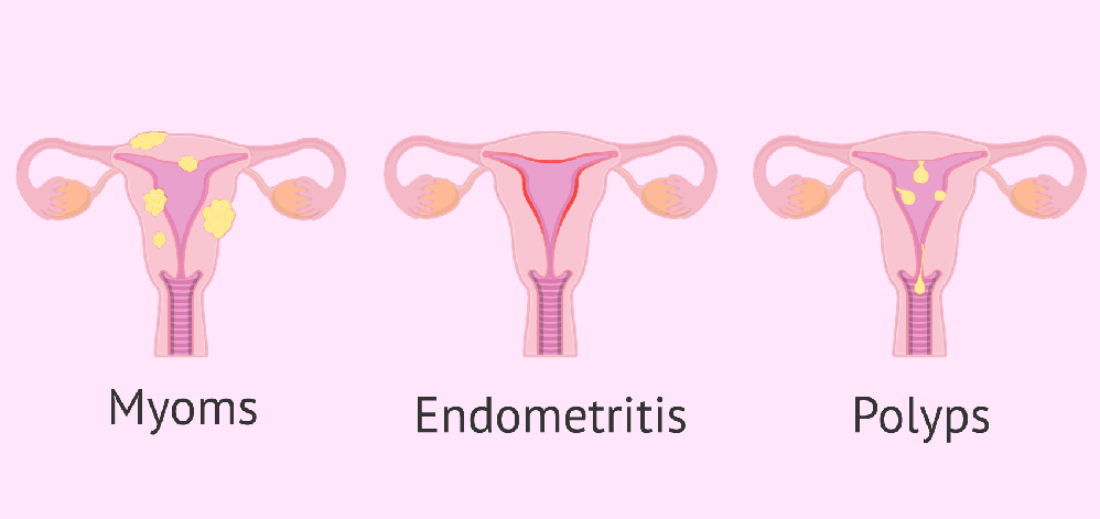 виды эндометрита