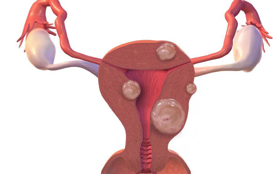 миома тела матки с аденомиозом