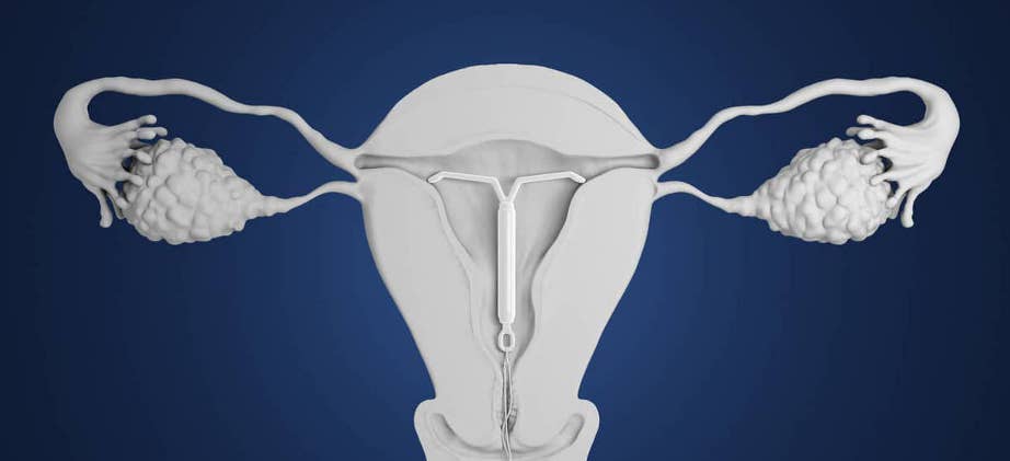 спираль мирена при эндометриозе матки