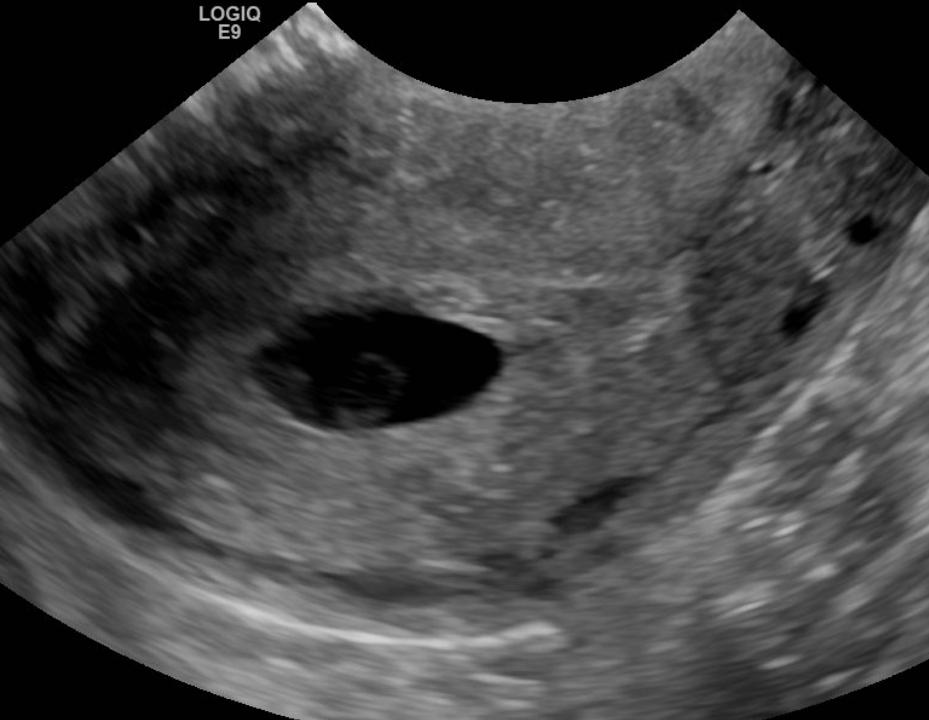 причины и последствия анэмбрионии